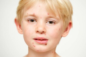 Ветрянка - 797fb2b5646cb06e3dbd049088.jpg