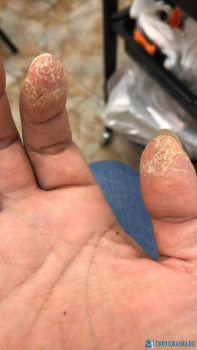 Проблема с кожей пальцев рук - C685E5C7-FFD9-413D-914E-6A3785C3DA13.jpeg